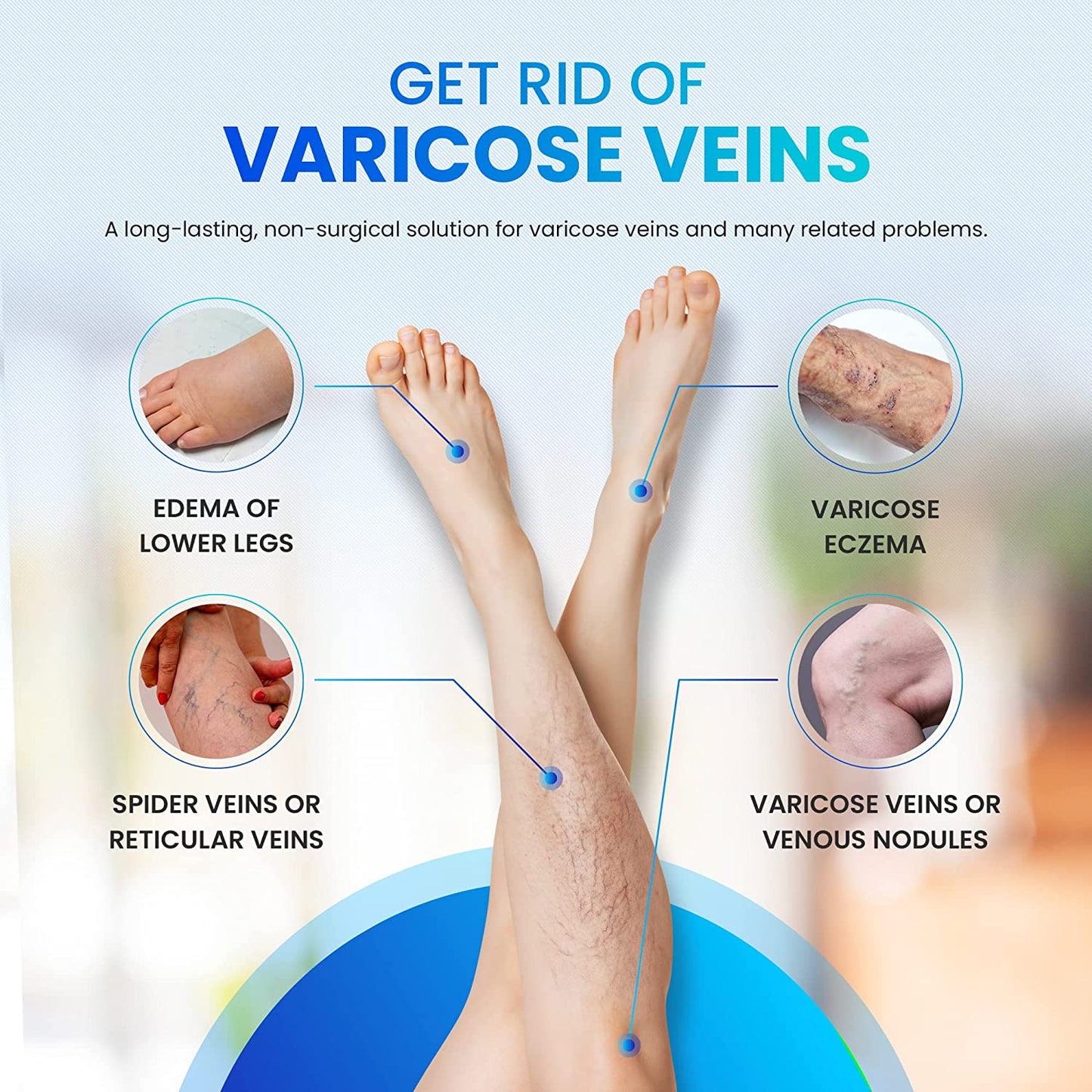 Varicose Veins