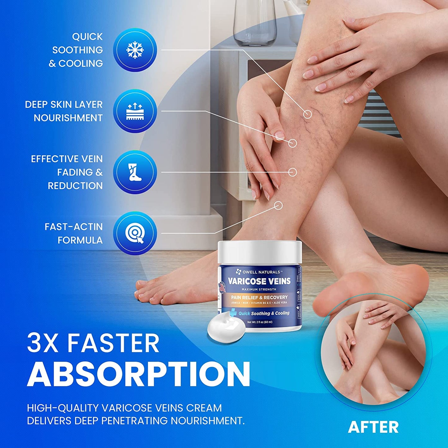 Varicose Veins
